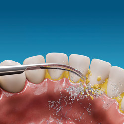 Set dentaire ultrasonique